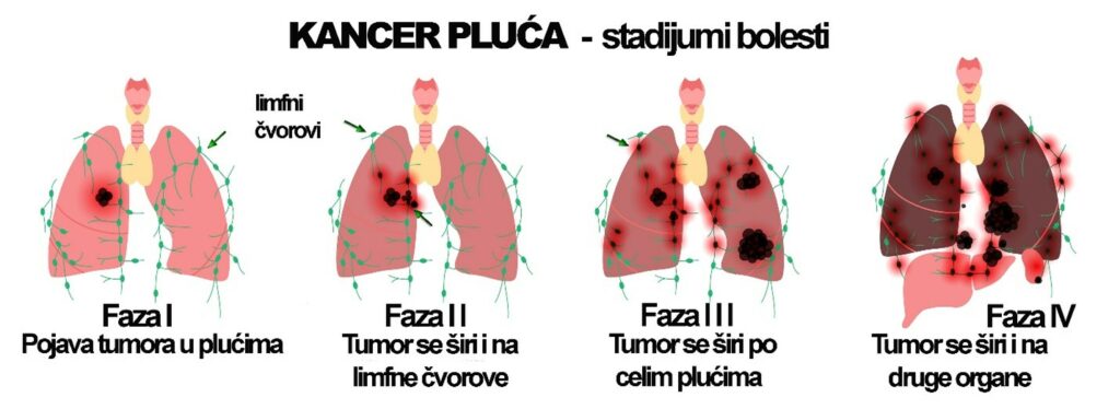 Rak pluća simptomi, faktori rizika i dijagnoza 1