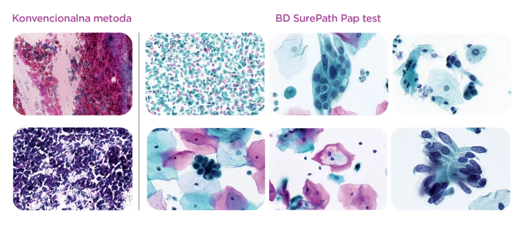 BD SurePath Liquid-based Pap Test 3